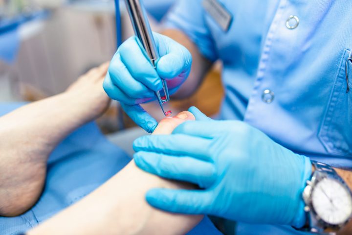 Laser Toenail Fungus Removal