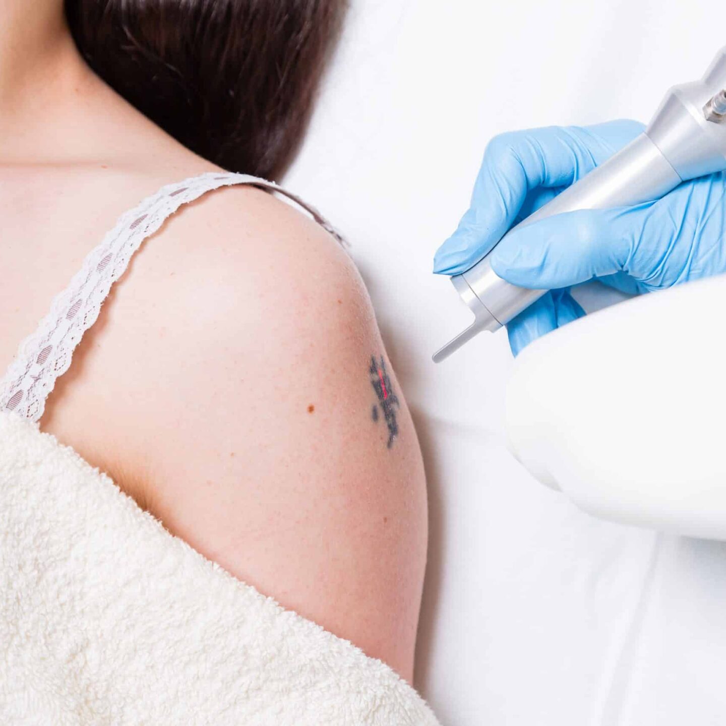 Laser Tattoo Removal