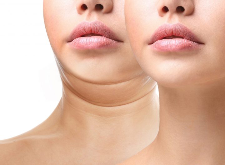 Kybella | Double Chin Treatment Kenai Peninsula - Cheeky Medspa