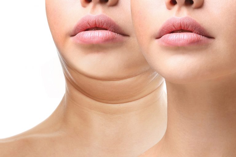 Kybella | Double Chin Treatment Kenai Peninsula - Cheeky Medspa