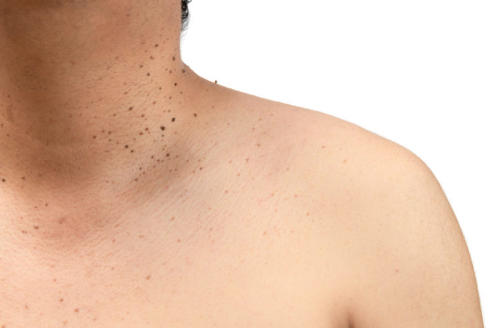 5 HomeRemedies to Get Rid of Skin Tag Removal From Body