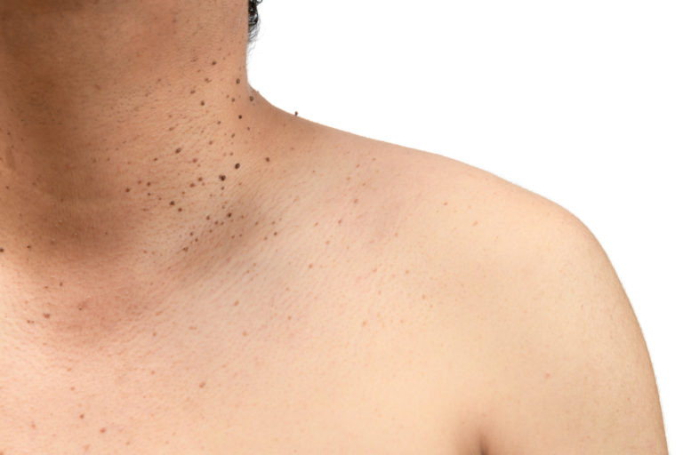 5 HomeRemedies to Get Rid of Skin Tag Removal From Body