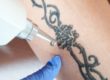 What is Laser Tattoo Reduction How Does It Work