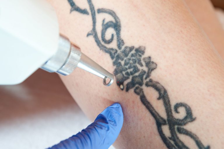 What is Laser Tattoo Reduction How Does It Work