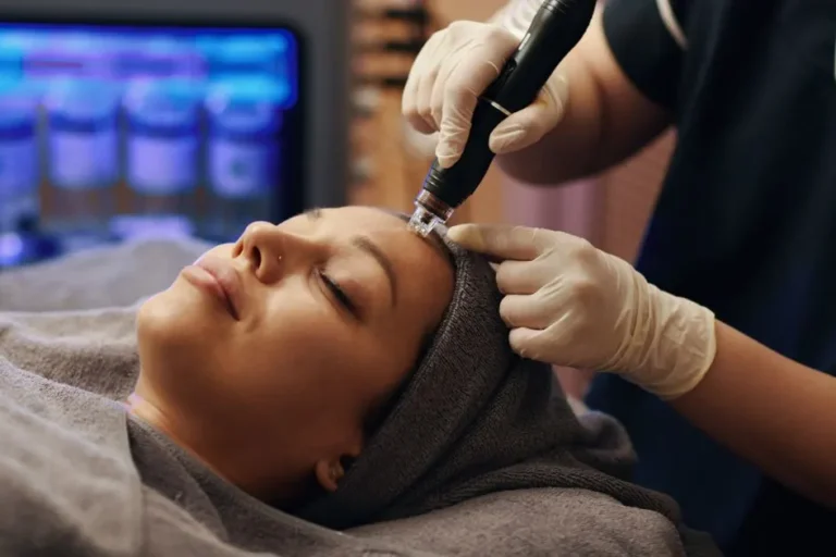 Professional administering microneedling for acne scars on a patient’s forehead using a SkinPen device.