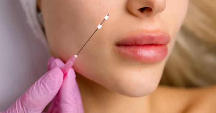 Close-up of a woman's face during a cosmetic procedure, with a gloved hand holding a needle near her cheek, highlighting PDO Thread in Kenai, Fairbanks & Homer, AK.