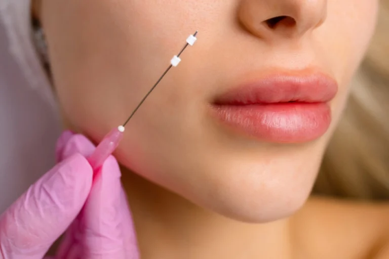 Close-up of a woman's face during a cosmetic procedure, with a gloved hand holding a needle near her cheek, highlighting PDO Thread in Kenai, Fairbanks & Homer, AK.