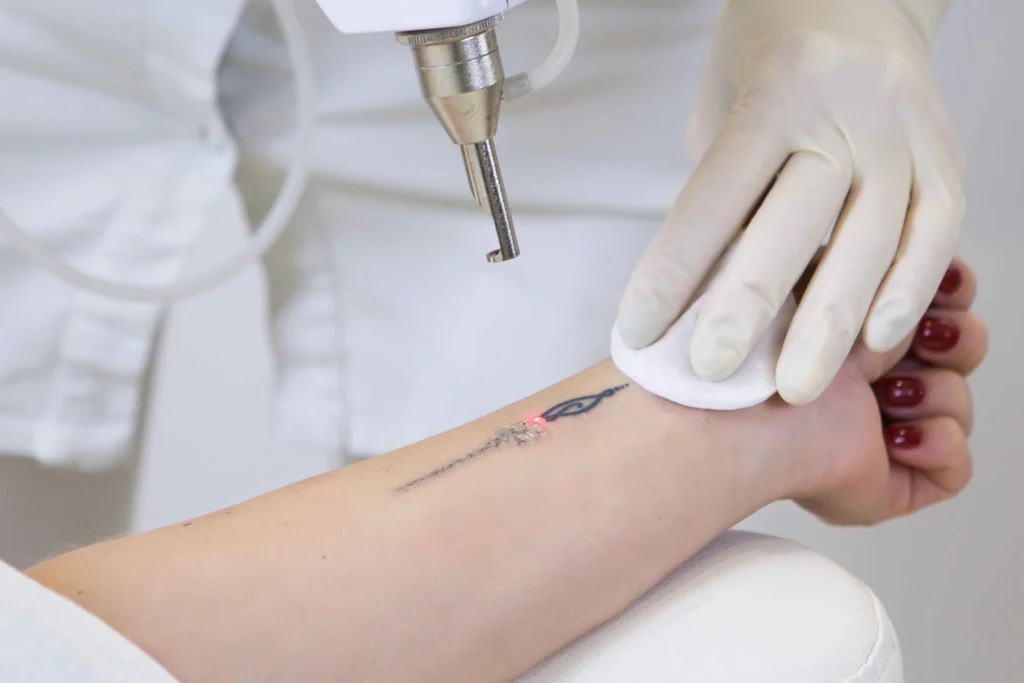 Laser Tatoo Removal