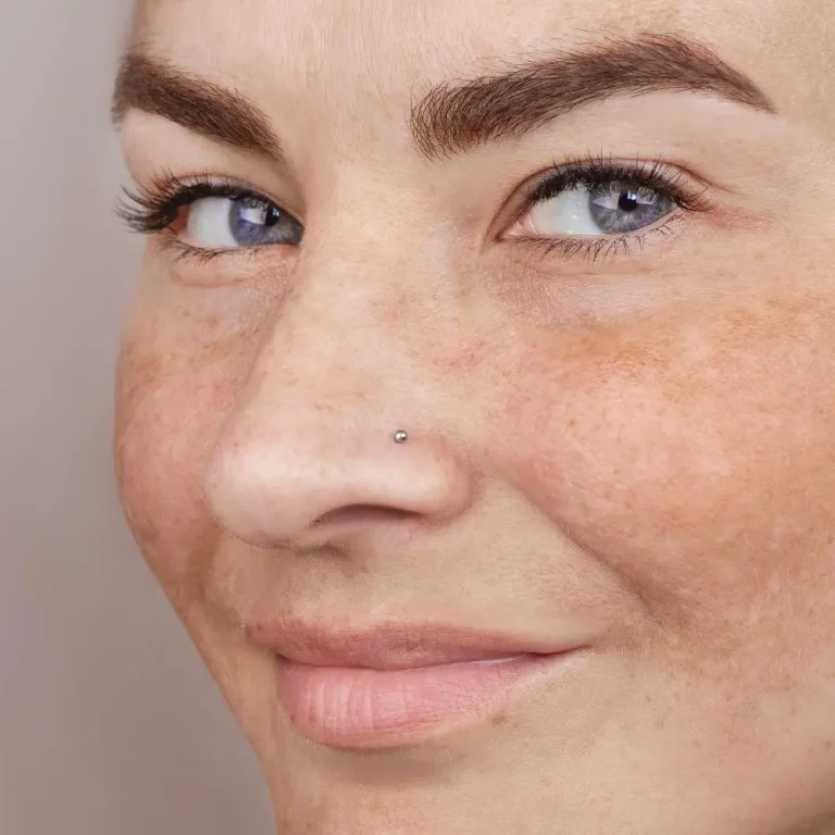 melasma_laser