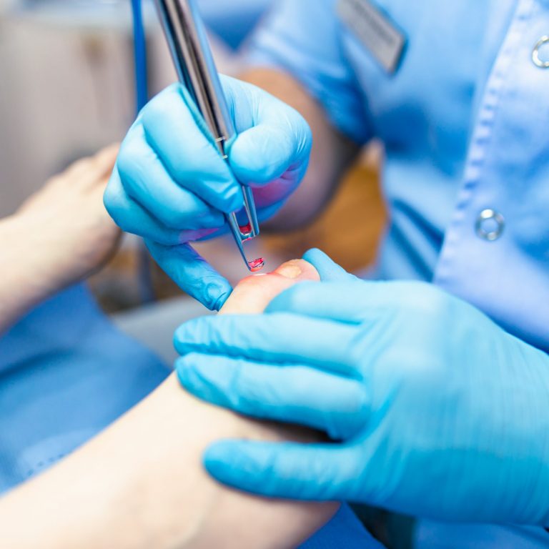 Laser Toenail Fungus Removal