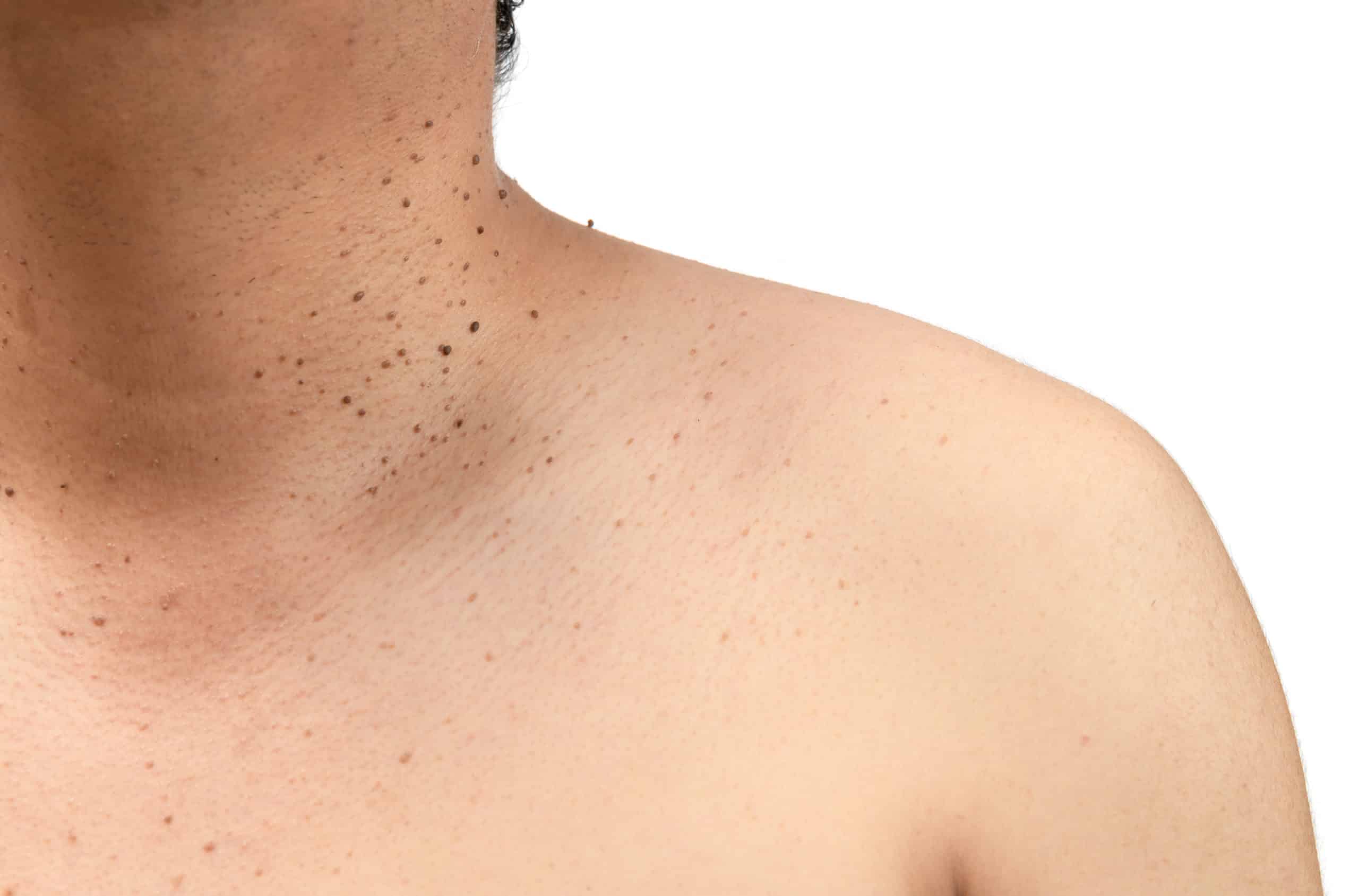 skin-tag-removal-5-home-remedies-to-get-rid-of-skin-tag