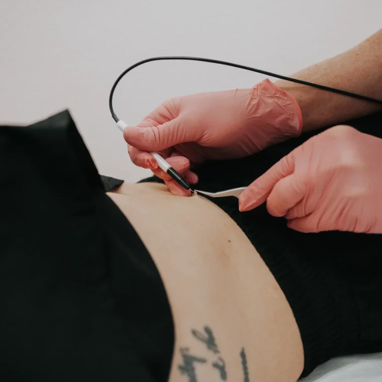 Skin Tag Removal